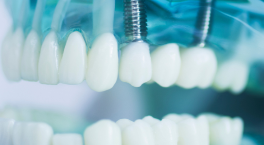 dental implants in midlothian